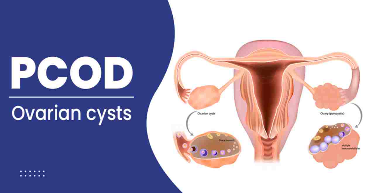 PCOD (Polycystic Ovarian Disease)- 13angle.com